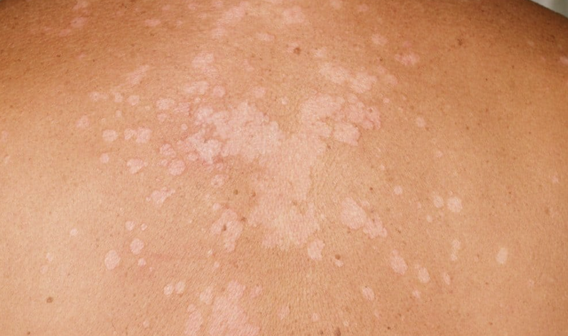 nam-men-malassezia-va-tac-dong-den-lan-da 3