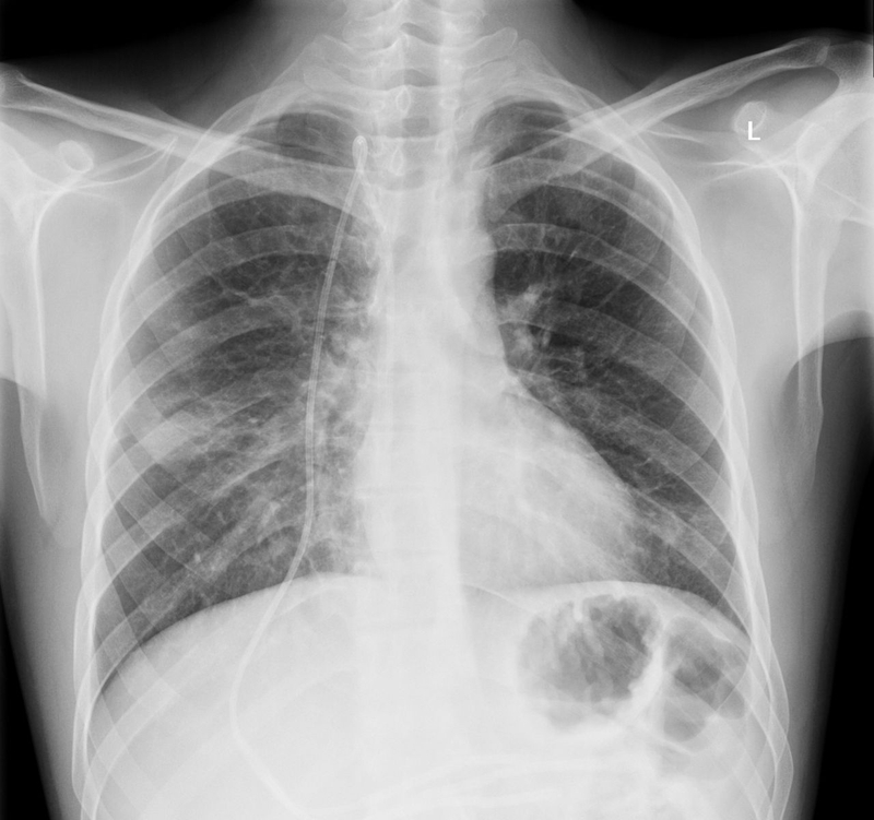 Nấm miệng nặng: Nguyên nhân, biến chứng và điều trị 4