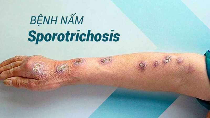 Nấm sâu sporotrichosis 02