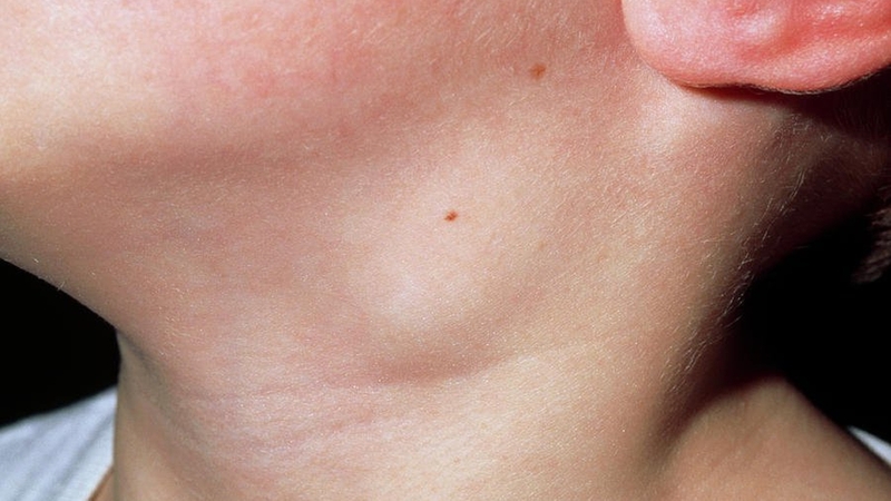 Nang bạch huyết vùng cổ, những điều cần biết2