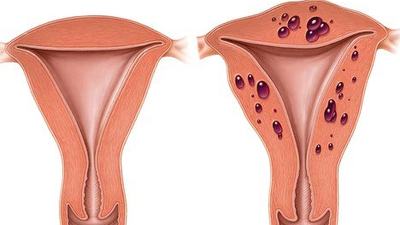 Nang buồng trứng trái liệu có nguy hiểm hay không?2