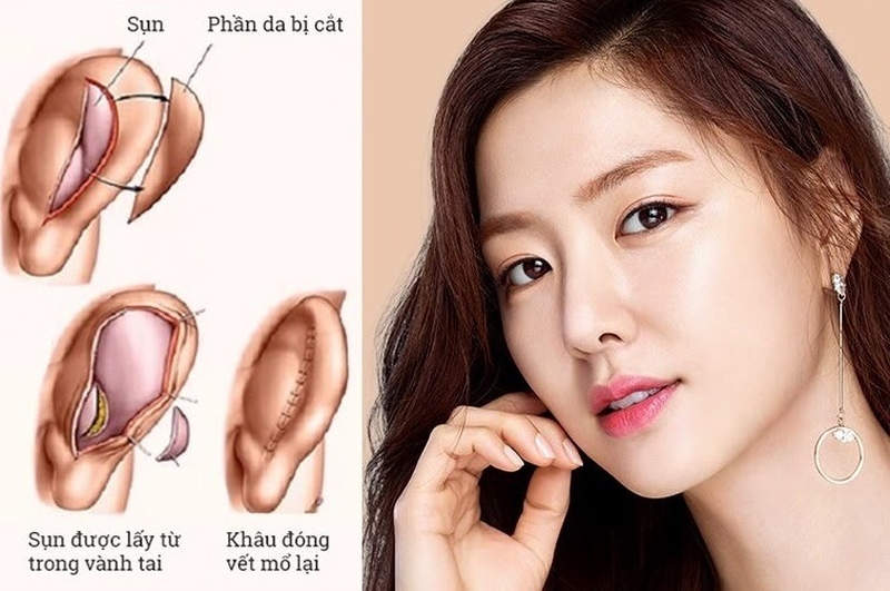 Nâng mũi bằng sụn tai