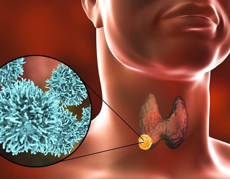 Nang tuyến giáp là gì? Cách phát hiện và điều trị nang tuyến giáp 2mm 1