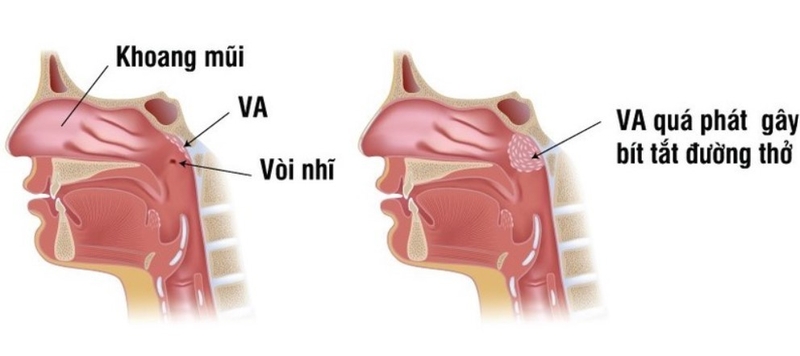 Nạo VA bằng dao plasma 03