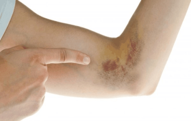 Ngã xe bị bầm tím và cách xử lý 2.png