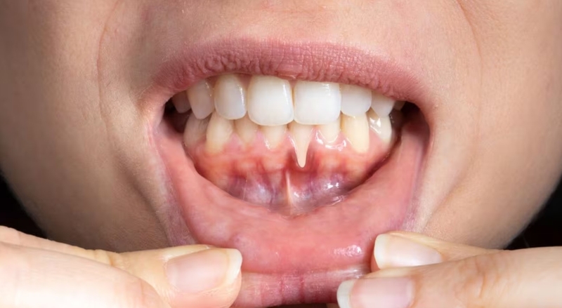 Nguyên nhân chảy máu chân răng 01