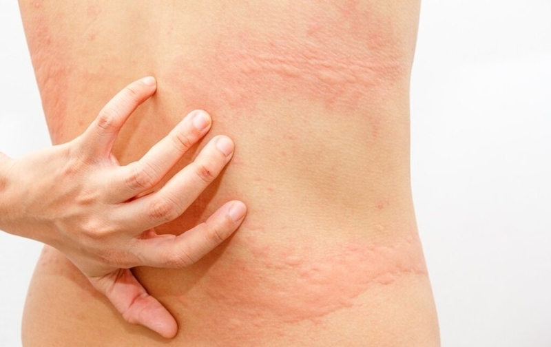 Nguyên nhân, dấu hiệu, cách chữa sốt siêu vi phát ban ở người lớn 5