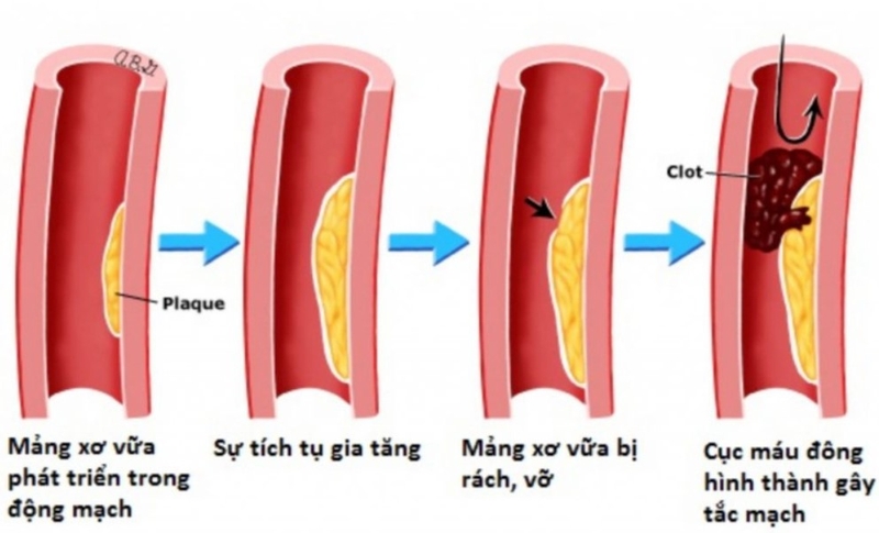 Nguyên nhân suy tim 03