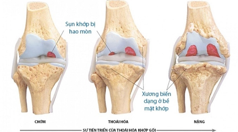 Nguyên nhân thoái hóa khớp gối 01