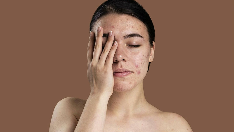 Nguyên nhân và dấu hiệu da nhiễm Corticoid là như thế nào 1