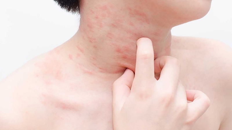 Nguyên nhân và dấu hiệu dị ứng mật ong như thế nào 2