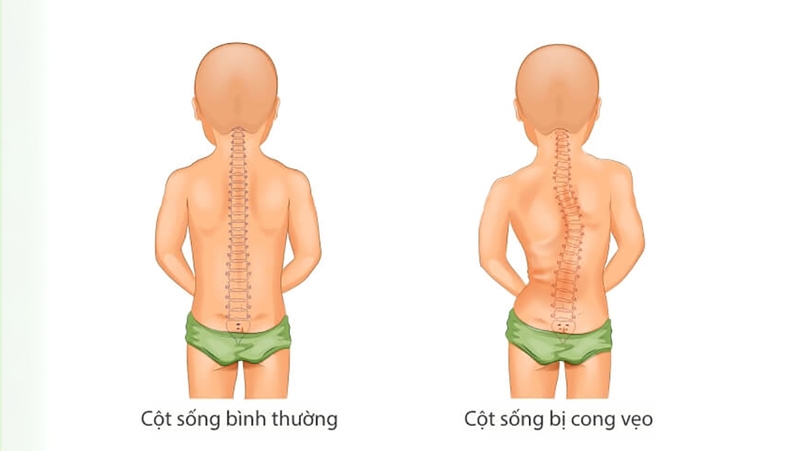 Nguyên nhân và dấu hiệu trẻ sơ sinh bị vẹo cột sống 2