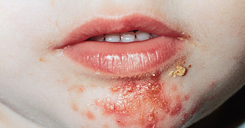 Nhận biết bệnh chốc lở ở trẻ sơ sinh và cách điều trị an toàn, hiệu quả 2