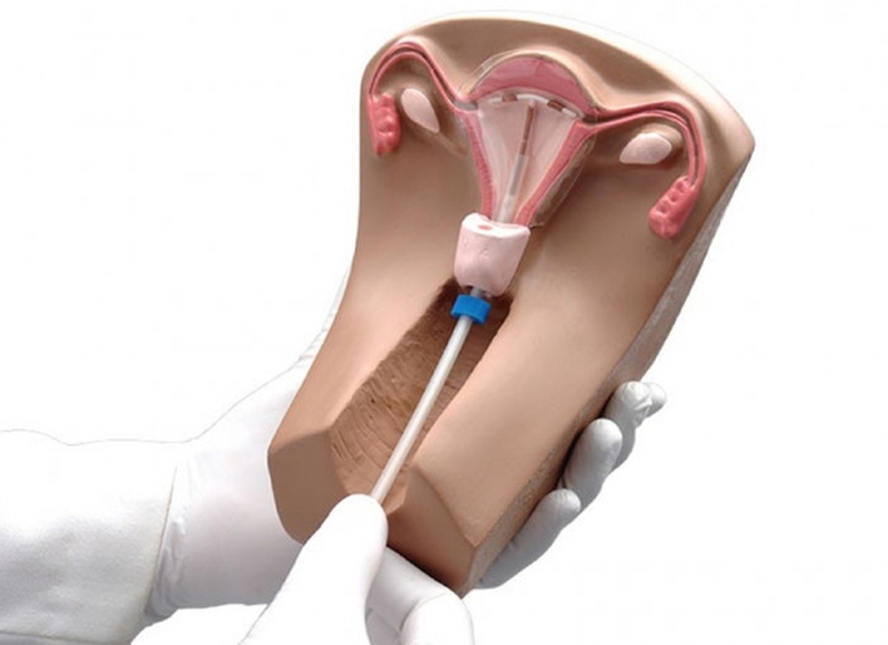 Nhận biết các dấu hiệu bạn nên tháo vòng tránh thai 1