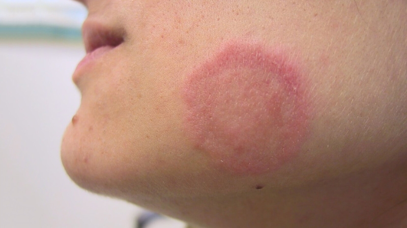 Nhận biết nhanh những dấu hiệu của bệnh hắc lào ở trẻ em 1