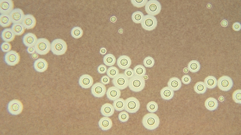 Nhiễm Cryptococcus 6.jpg