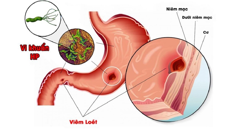 Vi khuẩn HP là gì? Nhiễm vi khuẩn HP có chữa khỏi được không 2