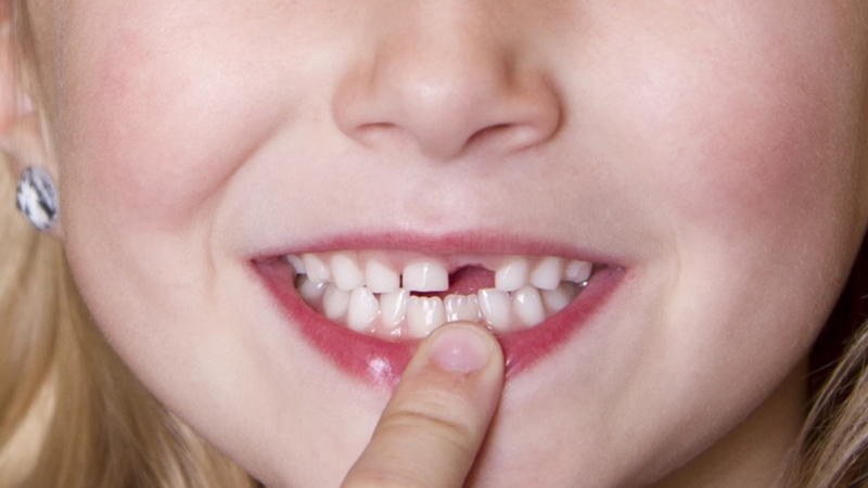 Nhổ răng cửa bao lâu thì trồng lại được 02