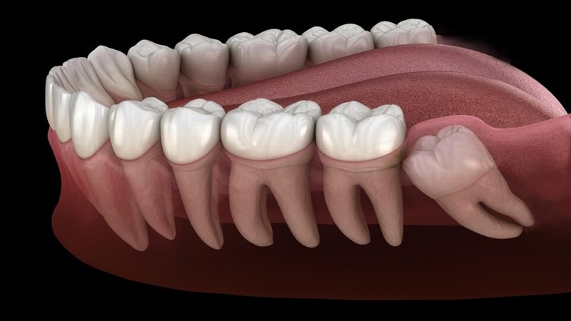 Nhổ răng khôn xong bị đau răng bên cạnh 02
