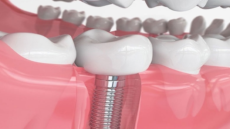 Nhổ răng số 7 có bị hóp má không? Bao lâu thì lành? 4