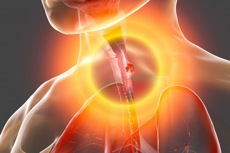 Những điều cần biết về chi phí phẫu thuật ung thư thực quản