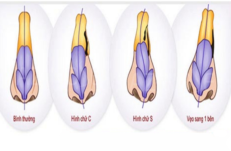 Lệch vách ngăn mũi là gì? Những điều cần biết về mổ lệch vách ngăn mũi 1