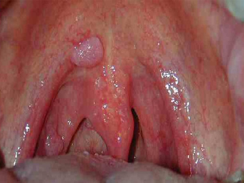 Hình ảnh ung thư vòm họng