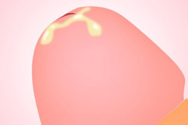 Những điều cần biết về tình trạng dương vật chảy mủ trắng đục 1