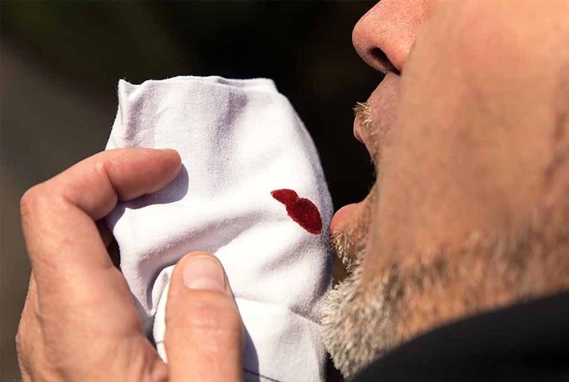 Những điều cần biết về u nấm phổi: Triệu chứng và cách điều trị 2