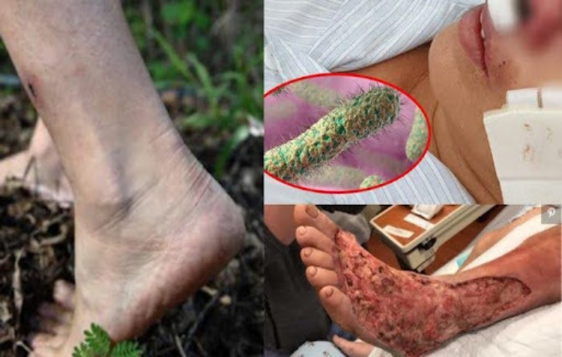 Nhung-dieu-can-biet-ve-viem-can-mac-hoai-tu 2.png