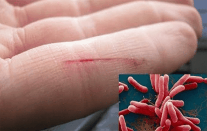 Nhung-dieu-can-biet-ve-viem-can-mac-hoai-tu 3.png