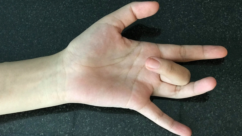 Những điều cần hiểu rõ về tình trạng viêm khớp ngón tay lò xo 1