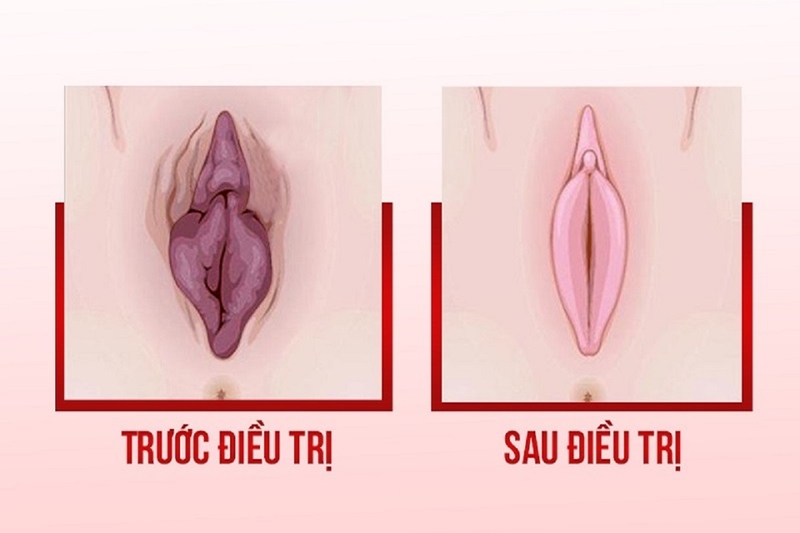 Những điều phái đẹp nên biết về tân trang cô bé. Có nên tân trang cô bé hay không? 2