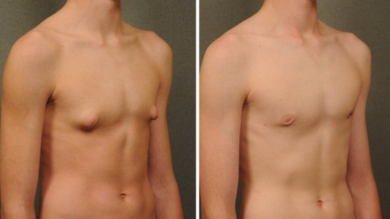 Những điều quan trọng nam giới cần biết về hội chứng Klinefelter 3