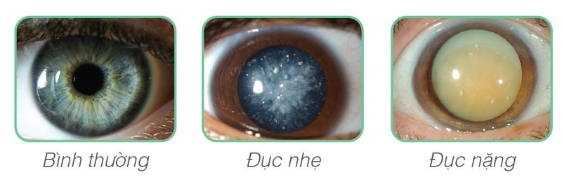 Nhược thị có di truyền không? 2