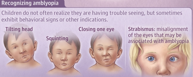 Nhược thị có mổ được không 2