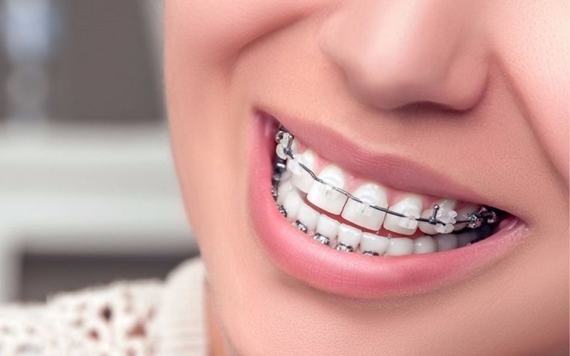 Niềng răng có gây đau không? Tác dụng và lợi ích khi niềng răng 1
