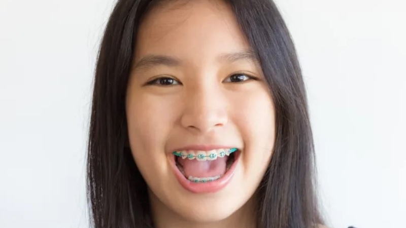 Niềng răng không nhổ răng có hiệu quả không 02