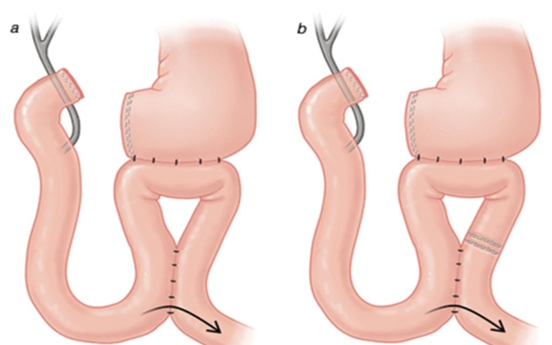 Nối dạ dày hỗng tràng là gì? Phương pháp nối và những lưu ý sau điều trị 1