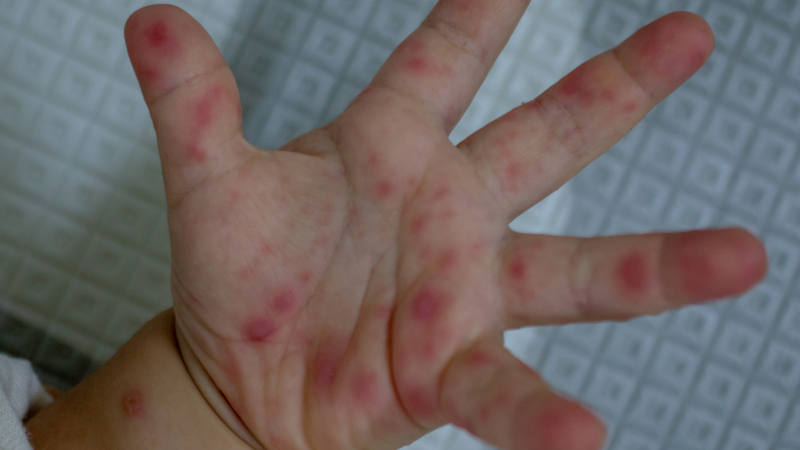 Virus tay chân miệng có mấy loại? Hiểu đúng để bảo vệ trẻ tốt hơn