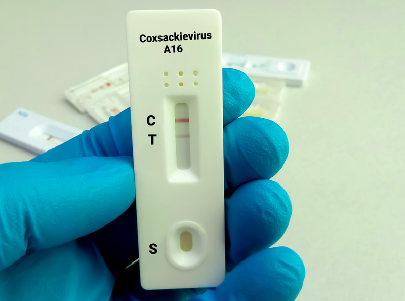 Coxsackievirus A16 là tác nhân phổ biến gây tay chân miệng ở trẻ nhỏ