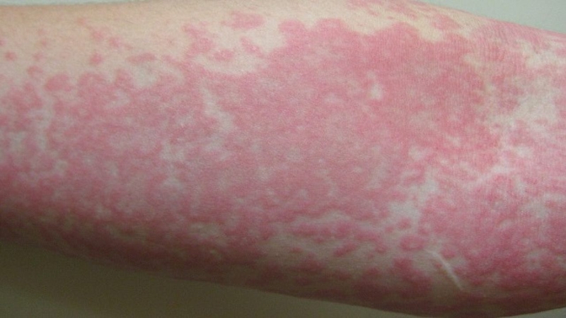 Nổi mề đay xông lá gì? 1