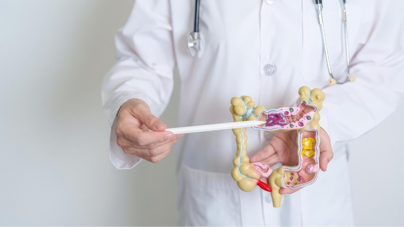 Nội soi đại tràng có gây mê giúp phát hiện viêm, u, polyp và tầm soát ung thư