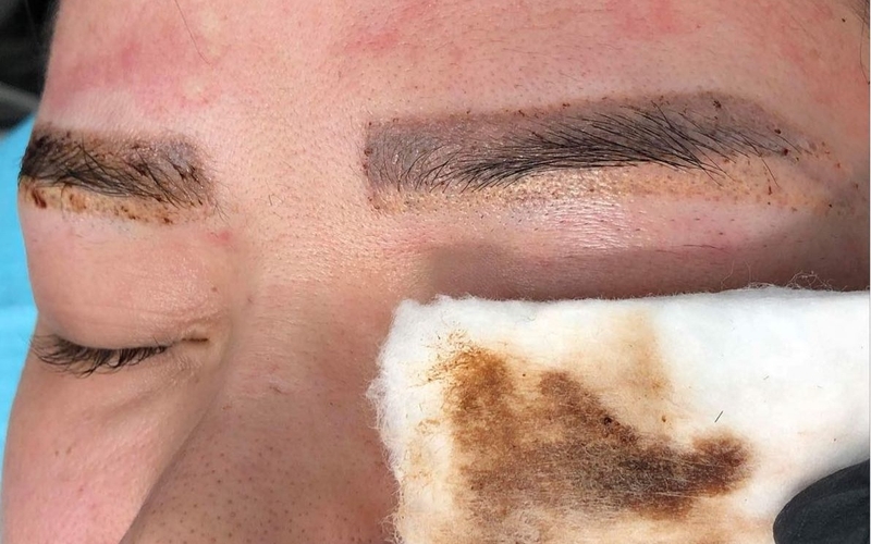 Quy trình xóa chân mày bằng laser như thế nào? Có đau không? 2