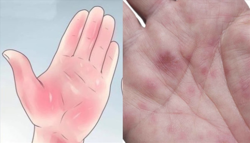 Nóng trong lòng bàn tay là triệu chứng bệnh gì? 3