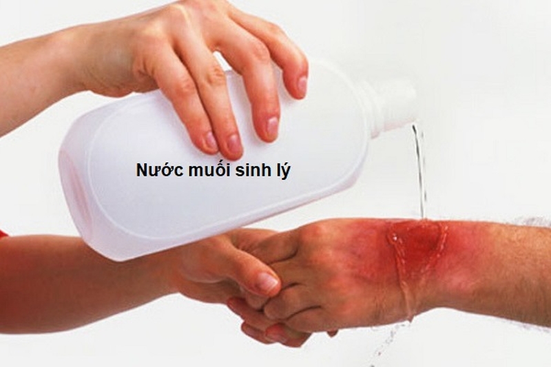 Hướng dẫn cách băng bó vết thương đúng chuẩn 1