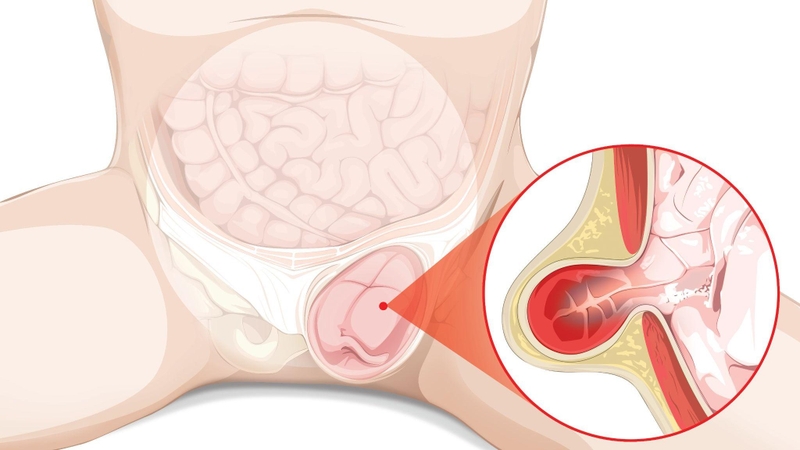 ỐNG PHÚC TINH MẠC 4.jpg