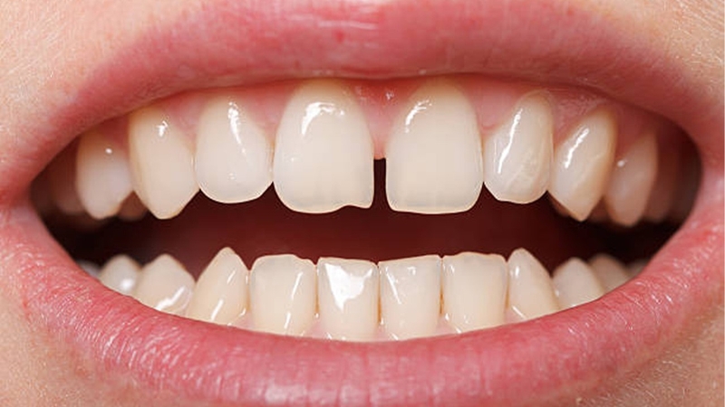 Răng sứ Orodent là gì? Khi nào cần bọc răng sứ? 2