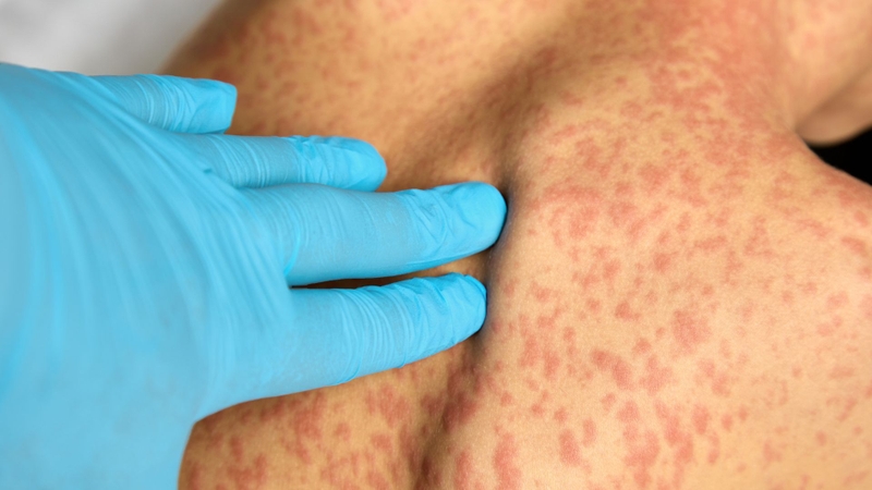 Nổi mề đay là một trong những tác dụng phụ của Pegloticase