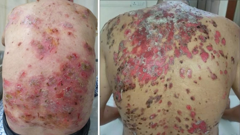 Pemphigus thông thường liên quan đến phản ứng tự miễn